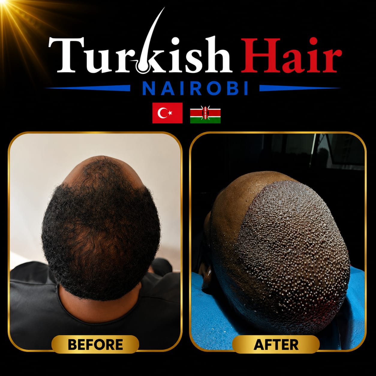 Turkish Hair Nairobi Case 2